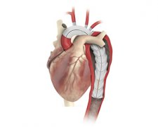 Vascutek Terumo Thoraflex Hybrid Stent Graft | Used in Endovascular aneurysm repair (EVAR)  | Which Medical Device